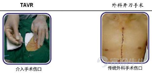 “微创系”心脏瓣膜巨头微创心通赴港上市 估值区间在哪？