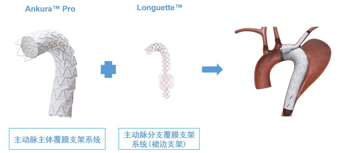 官宣！第13个！ ——先健科技主动脉覆膜支架系统获批创新“绿色通道”